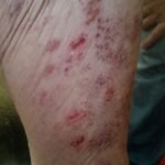 herpes-muslo-frente-2