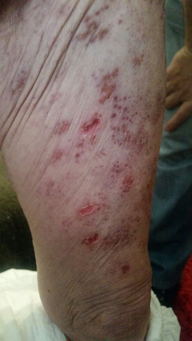herpes-muslo-frente-2