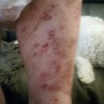 herpes-muslo-frente1