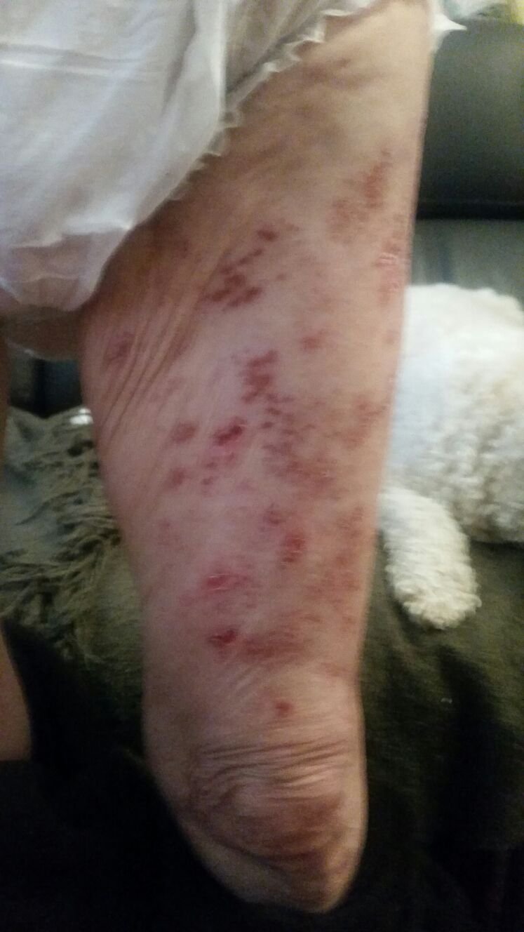 herpes-muslo-frente1